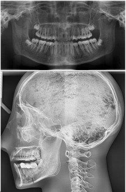 Fantom głowy z kręgami szyjnymi do radiografii (RTG) i CBCT, transparentny - Image no.: 4