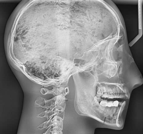 Fantom głowy z kręgami szyjnymi do radiografii (RTG) i CBCT, transparentny - Image no.: 5