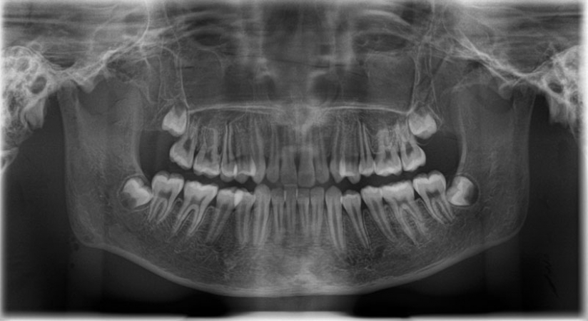 Fantom głowy z kręgami szyjnymi do radiografii (RTG) i CBCT, transparentny - Image no.: 9