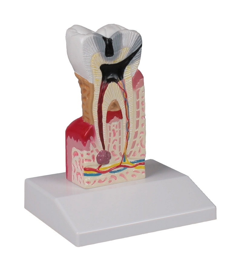 Model próchnicy zęba, powiększenie 10x - Image no.: 1