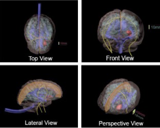 Fantom mózgu do diagnostyki MRI, CT i USG (Wersja zaawansowana) - Image no.: 2