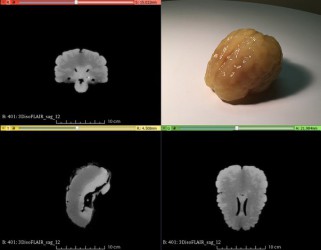 Fantom mózgu do biopsji pod kontrolą USG (Wersja podstawowa) - Image no.: 2
