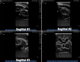 Zaawansowany fantom głowy noworodka do ultrasonografii (USG) - Image no.: 3