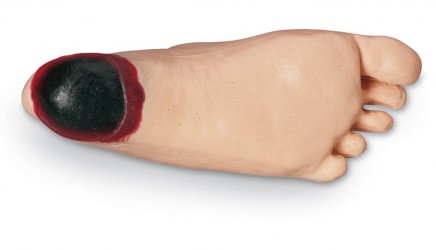 Stopa obrzękowa z głęboką martwicą tkanek - Image no.: 3