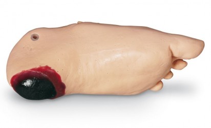Stopa obrzękowa z głęboką martwicą tkanek - Image no.: 4