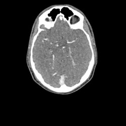 Fantom głowy i szyi do tomografii komputerowej, RTG i radioterapii - Image no.: 3