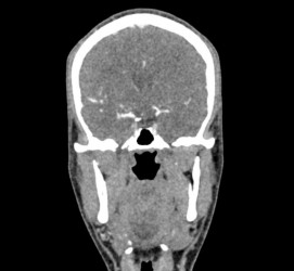 Fantom głowy i szyi do tomografii komputerowej, RTG i radioterapii - Image no.: 6