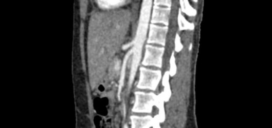 Fantom brzucha do tomografii komputerowej, RTG i radioterapii - Image no.: 3