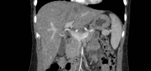Fantom brzucha do tomografii komputerowej, RTG i radioterapii - Image no.: 4