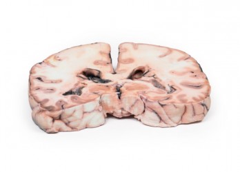 Model anatomiczny glejaka mózgu 3-4 stopnia powodujący obrzęk tarczy nerwu wzrokowego - Image no.: 3