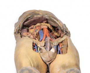 Model anatomiczny jamy brzusznej z obustronną przepukliną - Image no.: 3