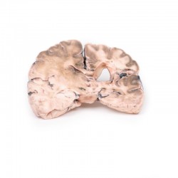 Model anatomiczny zawału lewej półkuli mózgu - Image no.: 2