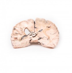 Model anatomiczny zawału lewej półkuli mózgu - Image no.: 1
