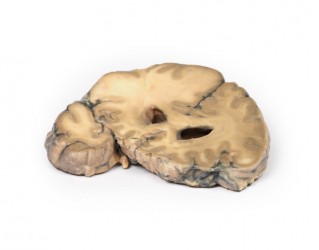 Model anatomiczny gruczolakoraka z przerzutami w mózgu - Image no.: 2