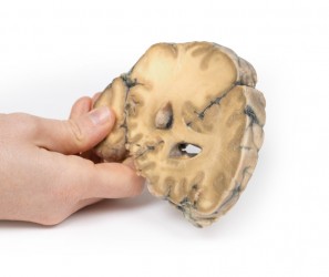 Model anatomiczny gruczolakoraka z przerzutami w mózgu - Image no.: 3