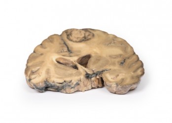 Model anatomiczny gruczolakoraka z przerzutami w mózgu - Image no.: 1