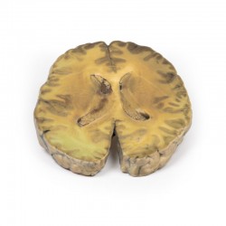 Model anatomiczny zapalenia komór mózgu, wtórne do sepsy - Image no.: 2