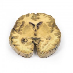 Model anatomiczny zapalenia komór mózgu, wtórne do sepsy - Image no.: 1