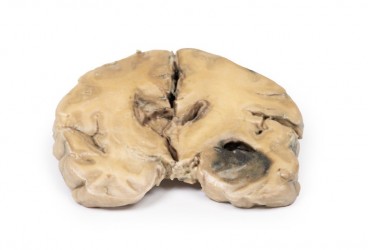 Model anatomiczny glejaka wielopostaciowego mózgu - Image no.: 2