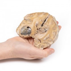 Model anatomiczny glejaka wielopostaciowego mózgu - Image no.: 3