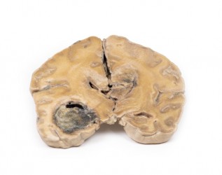 Model anatomiczny glejaka wielopostaciowego mózgu - Image no.: 1