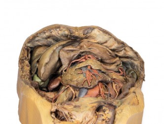 Model anatomiczny jamy brzusznej- przepuklina pachwinowa - Image no.: 2
