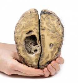 Model anatomiczny nowotworu z przerzutami w mózgu (stadium IV raka) - Image no.: 4