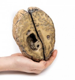 Model anatomiczny nowotworu z przerzutami w mózgu (stadium IV raka) - Image no.: 5