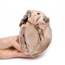 Model anatomiczny podzastawkowego zwężenia aorty - Image no.: 5