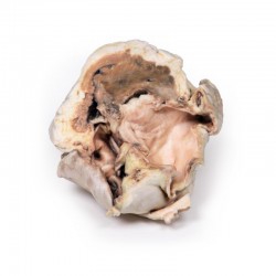 Model anatomiczny zwężenia zastawki aortalnej - zastawka dwupłatkowa - Image no.: 2