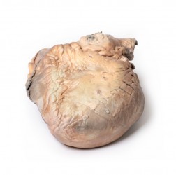 Model anatomiczny pęknięcia tętniaka aorty piersiowej  - Image no.: 2