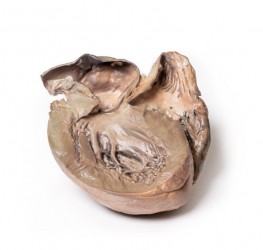Model anatomiczny pęknięcia tętniaka aorty piersiowej  - Image no.: 1