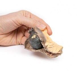 Model anatomiczny niedrożności jelit wywołanej kamieniem żółciowym - Image no.: 4