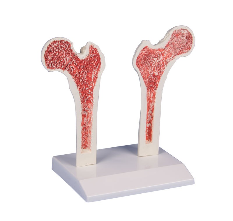 Porównawczy model kości udowej: Kość zdrowa / Kość osteoporotyczna  - Image no.: 1