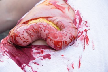 Model rany - wypadnięcie jelita grubego po uszkodzeniu ściany brzucha - Image no.: 5