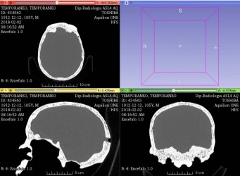 Czaszka osoby dorosłej do USG, CT i MRI - Image no.: 3