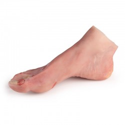 Model stopy cukrzycowej, ciężkie stadium choroby - Image no.: 2