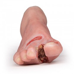 Model stopy cukrzycowej, ciężkie stadium choroby - Image no.: 4