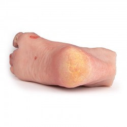 Model stopy cukrzycowej, ciężkie stadium choroby - Image no.: 5