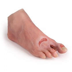 Model stopy cukrzycowej, ciężkie stadium choroby - Image no.: 1